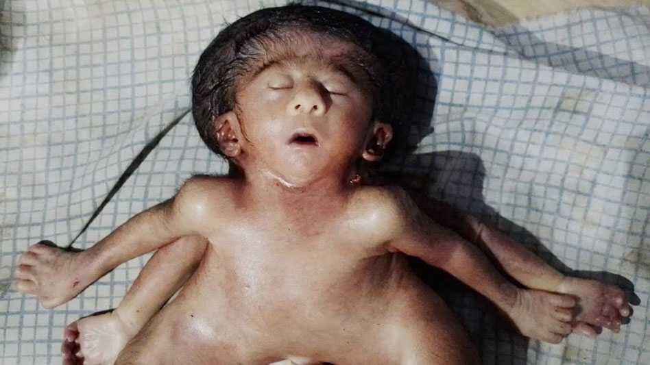 Bihar Surprising Baby Girl Born
